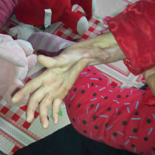 妤心植皮后,出現了非常嚴重的疤痕增生現象 妤心植皮后,出現了非常嚴重的疤痕增生現象